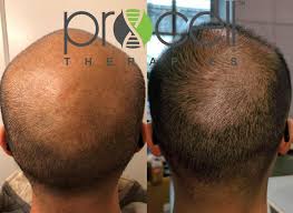 Erase Esthetics Microchanneling Hair Treatments